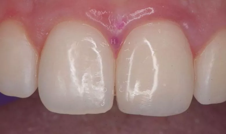 Где лучшая стоматология? Реставрация зуба с восстановлением естественной формы - фото после процедуры