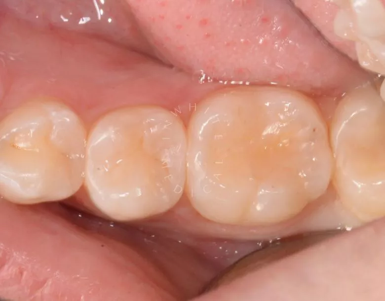 Лучшие зубные клиники Москвы. Поверхностный кариес фиссур – терапия без осложнений - фото до процедуры