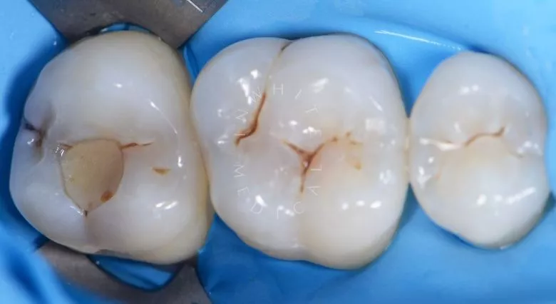 Фото до Художественная реставрация зубов после лечения кариеса в клинике Inwhite Medical