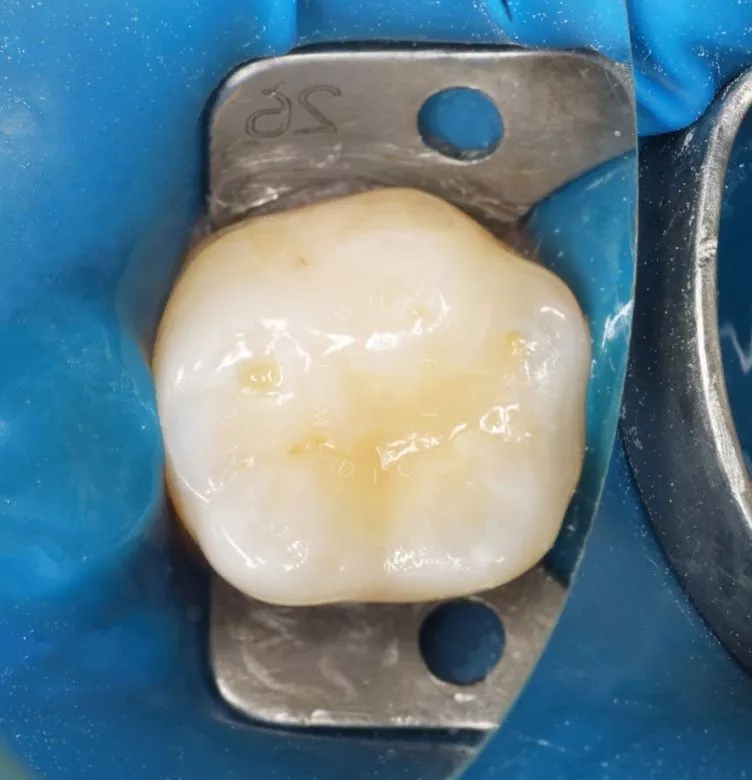 Где лучшая стоматология? Скрытый кариес: диагностика и лечение - фото после процедуры