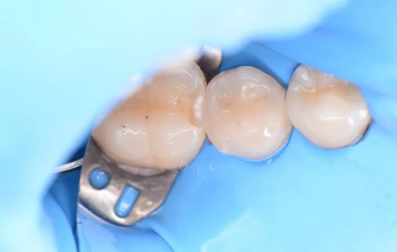 Где лучшая стоматология? Скрытый межзубный кариес – диагностика и лечение - фото до процедуры