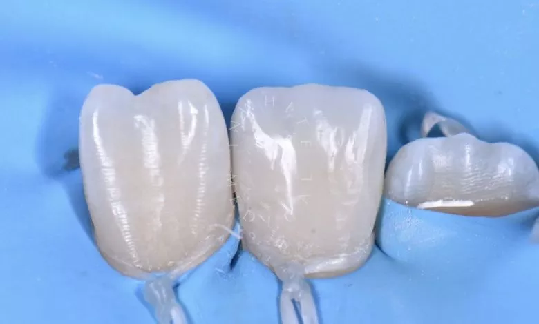 Где лучшая стоматология? Прямая реставрация центрального резца нижней челюсти - фото после процедуры