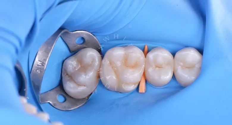 Фото после Комплексное лечение кариесов зубов в клинике Inwhite Medical