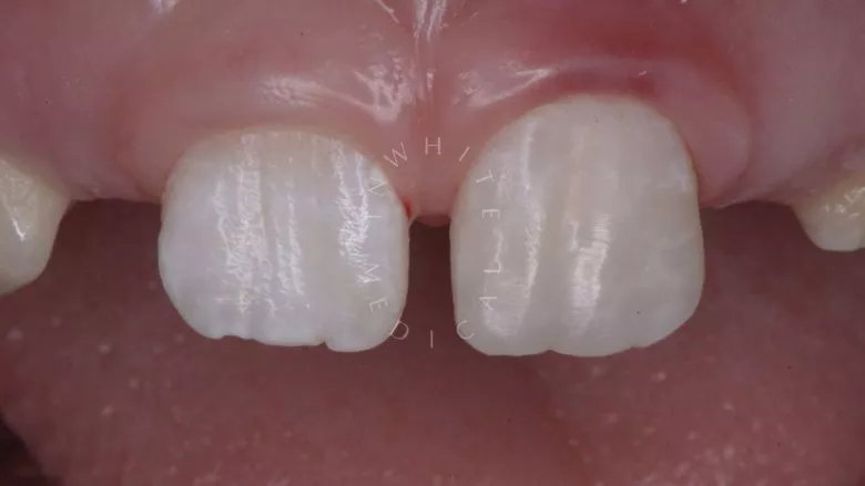 Где лучшая стоматология? Прямая реставрация с использованием композитного материала в одно посещение - фото после процедуры
