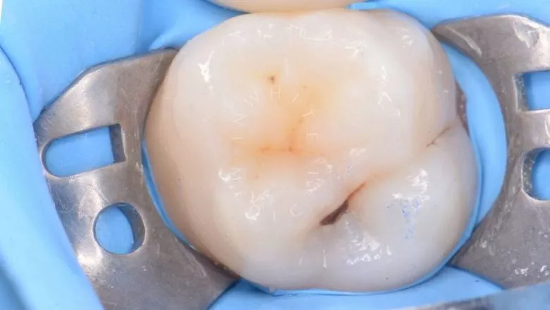 Где лучшая стоматология? Лечение кариеса. Композитная реставрация с восстановлением функциональных ориентиров - фото до процедуры