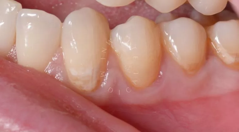 Лучшие зубные клиники Москвы. Пришеечный кариес переднего зуба – художественная реставрация - фото до процедуры