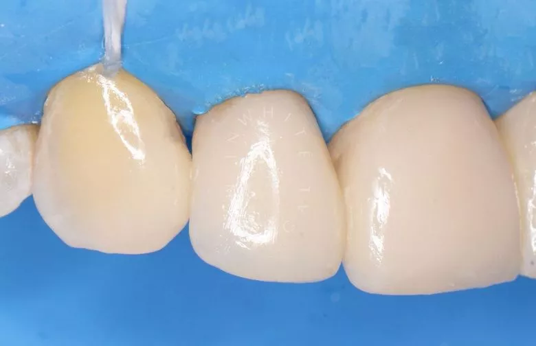 Фото после Лечение кариеса с эстетической реставрацией в клинике Inwhite Medical