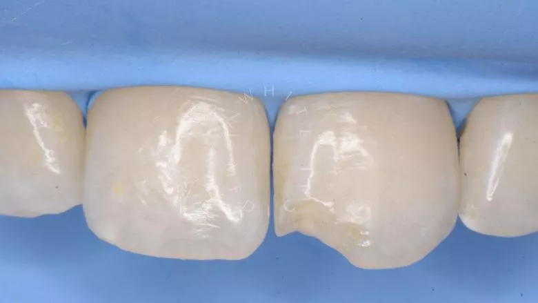 Где лучшая стоматология? Художественная реставрация переднего зуба с использованием композита. Восстановление оптики зуба - фото до процедуры