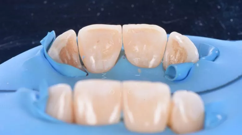 Элитная стоматология. Реставрация фронтальных зубов после лечения кариеса - фото после процедуры