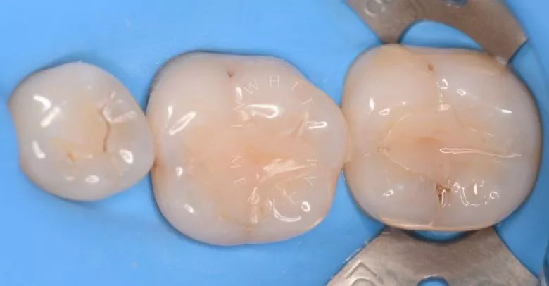 Фото до Современное лечение кариеса под увеличением в клинике Inwhite Medical