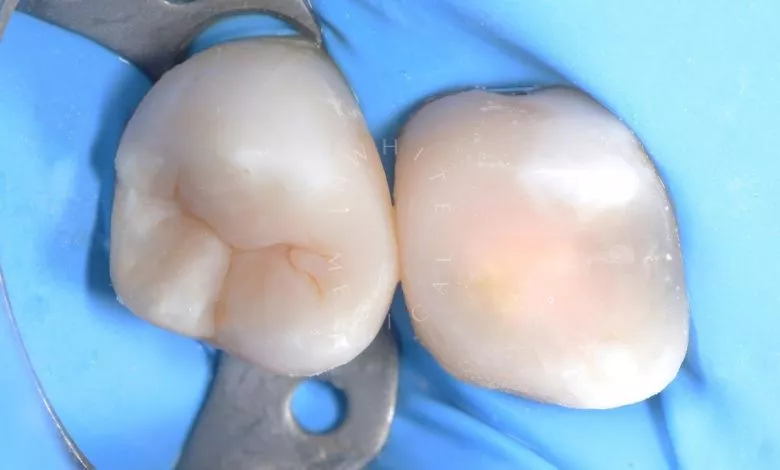 Фото после Замена старой пломбы с повторным лечением кариеса в клинике Inwhite Medical