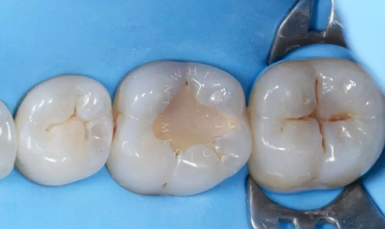 Фото до Фиссурный кариес: лечение и восстановление естественных фиссур в клинике Inwhite Medical