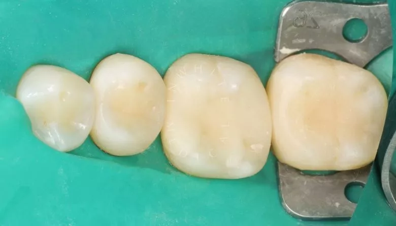 Где лучшая стоматология? Поверхностный кариес: лечение на ранней стадии - фото после процедуры