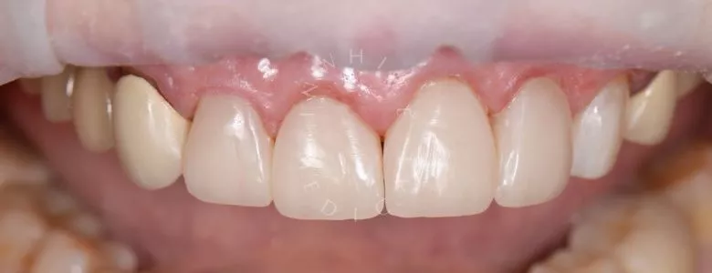 Фото после Композитная реставрация 4 верхних зубов в зоне улыбки в клинике Inwhite Medical