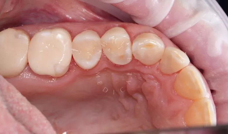 Лучшие стоматологические клиники Москвы.  Лечение нескольких кариесов зубов за один визит в рамках подготовки к протезированию - фото после процедуры