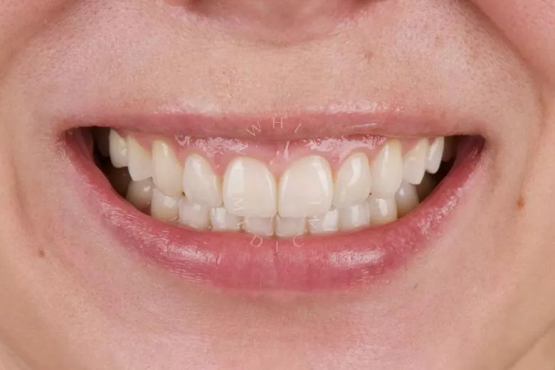 Фото после Керамические виниры и коронки для улучшения эстетики в зоне улыбки в клинике Inwhite Medical