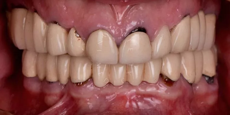 Лучшие клиники стоматологии. Тотальная реабилитация - имплантация all-in-6 и замена керамических виниров и коронок - фото до процедуры