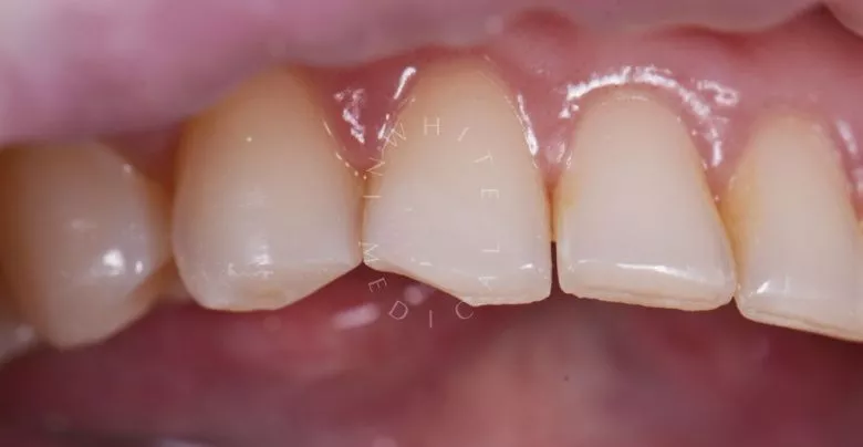 Лучшие зубные клиники Москвы. Реставрация сколов зуба - фото до процедуры