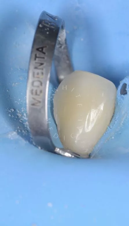 Где лучшая стоматология? Лечение пришеечного глубокого кариеса с использованием микроскопа - фото после процедуры