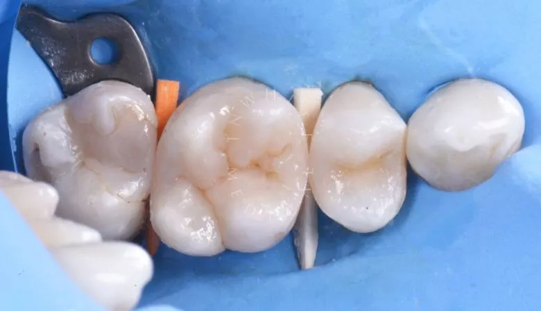 Лучшие зубные клиники Москвы. Средний кариес: лечение и восстановление зуба - фото после процедуры