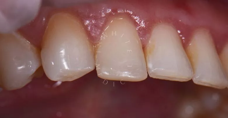 Лучшие зубные клиники Москвы. Реставрация сколов зуба - фото после процедуры