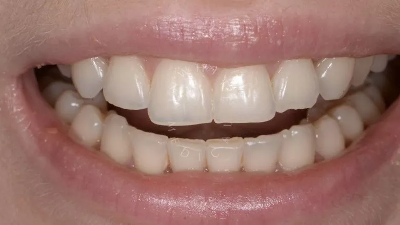 Где лучшая стоматология? Художественная реставрация формы зубов - фото до процедуры