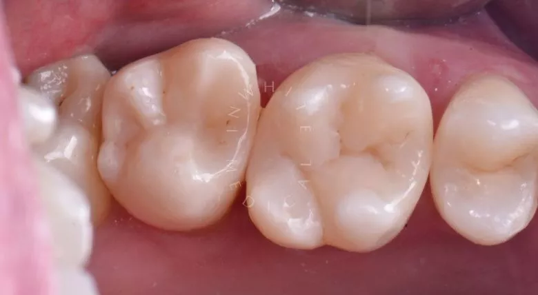 Фото после Контактный кариес под старой пломбой в клинике Inwhite Medical