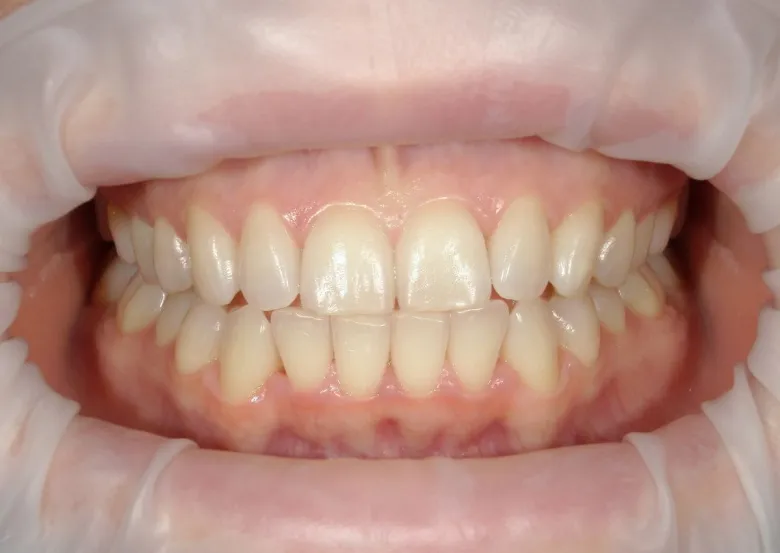 Фото до Отбеливание в клинике Inwhite Medical