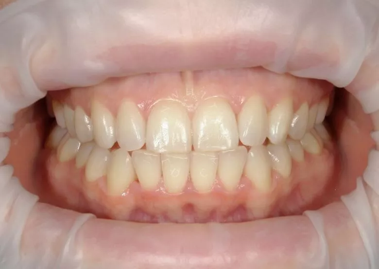 Фото до Отбеливание в клинике Inwhite Medical