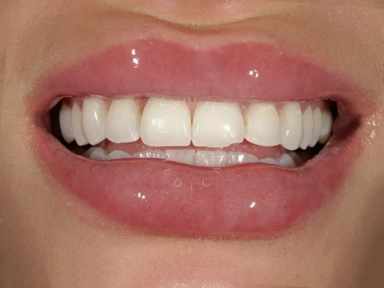 Фото после Отбеливание зубов в Москве в клинике Inwhite Medical