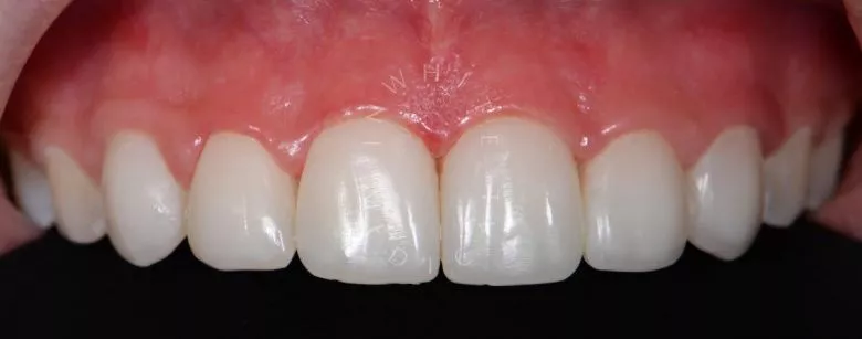 Фото после Композитные виниры в зоне улыбки в клинике Inwhite Medical