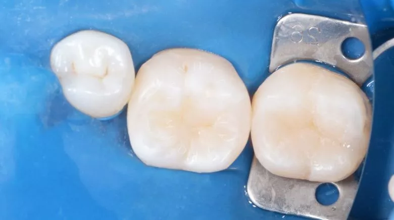 Лучшие стоматологические клиники Москвы. Замена старых реставраций с улучшением эстетики зубов - фото после процедуры