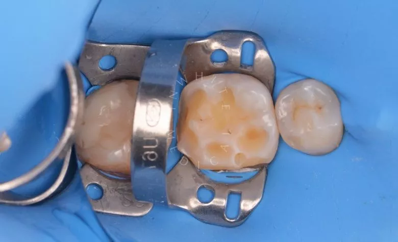 Элитная стоматология. Лечение множественного кариеса и композитная реставрация зуба - фото до процедуры
