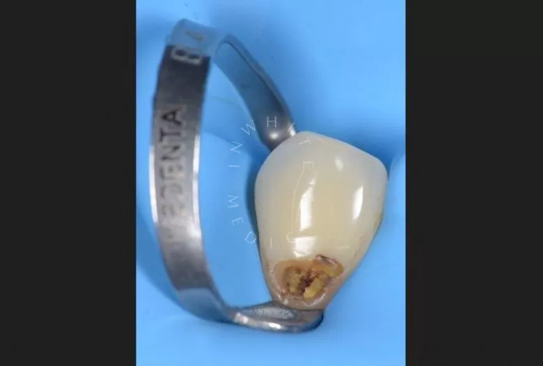 Где лучшая стоматология? Лечение клиновидного дефекта - фото до процедуры