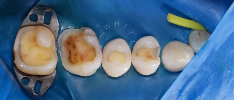 Фото до Лечение 4 зубов за один визит в клинике Inwhite Medical