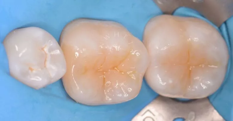 Лучшие стоматологические клиники Москвы. Современное лечение кариеса под увеличением - фото после процедуры