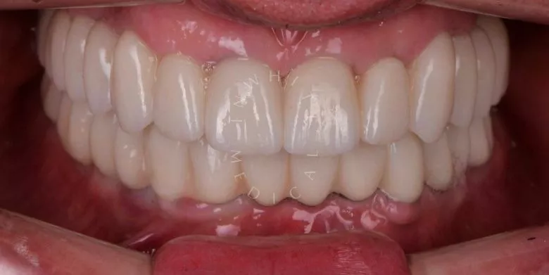 Лучшие клиники стоматологии. Тотальная реабилитация - имплантация all-in-6 и замена керамических виниров и коронок - фото после процедуры