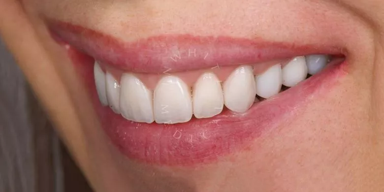 Фото после процедуры