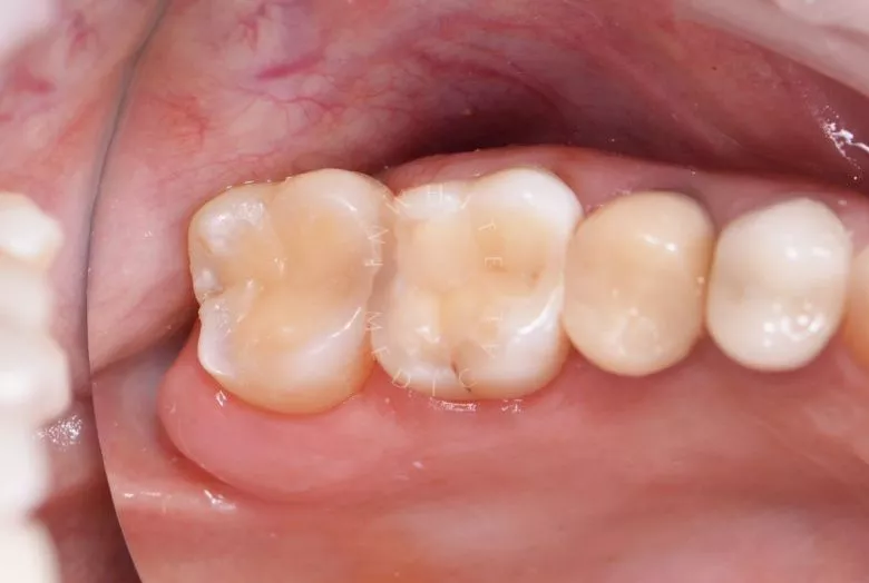 Фото после Лечение глубокого кариеса в клинике Inwhite Medical