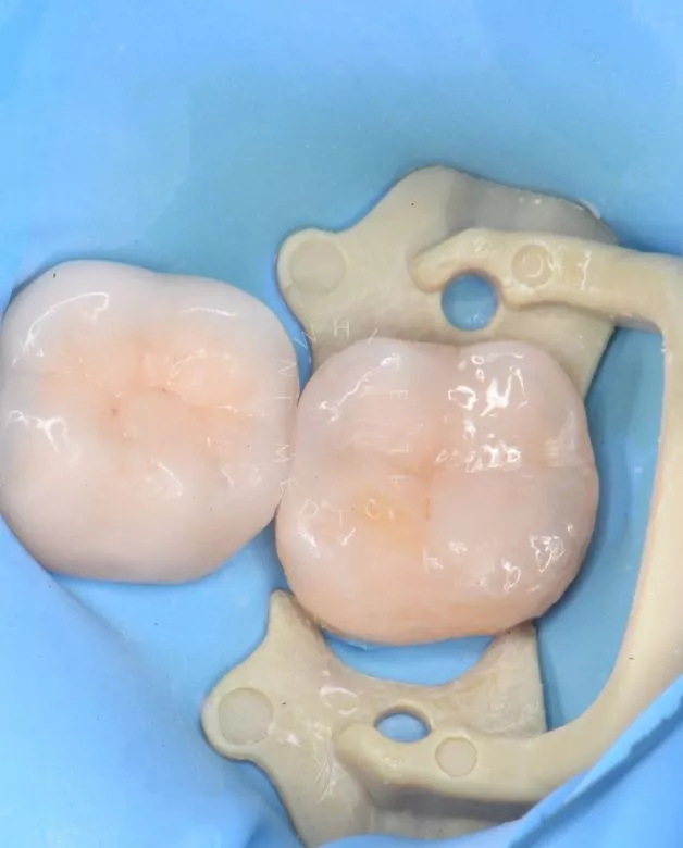 Где лучшая стоматология? Лечение фиссурного кариеса под увеличением - фото после процедуры