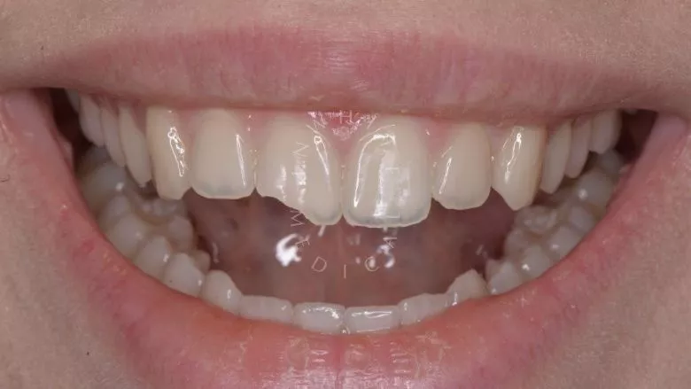 Где лучшая стоматология? Художественная реставрация зуба композитным материалом с восстановлением всех оптических характеристик за один визит. - фото до процедуры