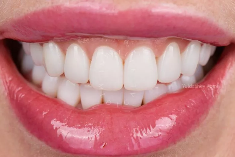 Фото после Замена керамических виниров и коронок в клинике Inwhite Medical