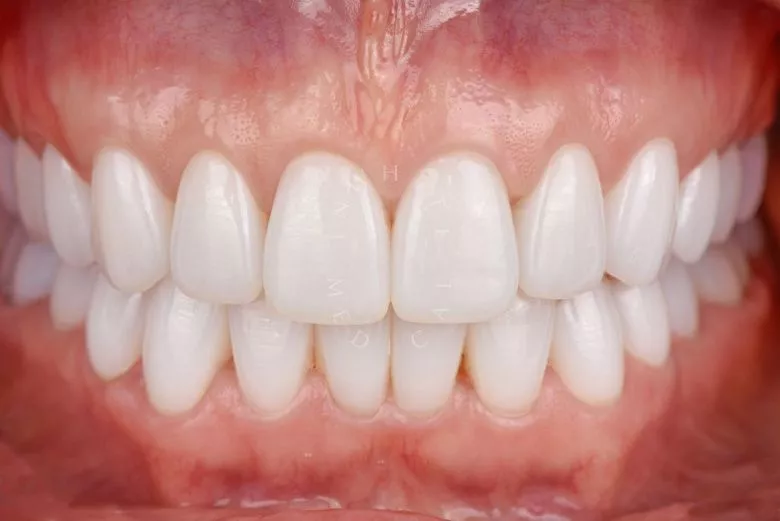 Фото после Замена керамических виниров и коронок в клинике Inwhite Medical