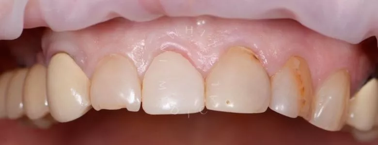 Фото до Композитная реставрация 4 верхних зубов в зоне улыбки в клинике Inwhite Medical