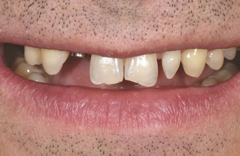 Стоматология премиум. Возвращение эстетики улыбки - установка керамических виниров и коронок - фото до процедуры