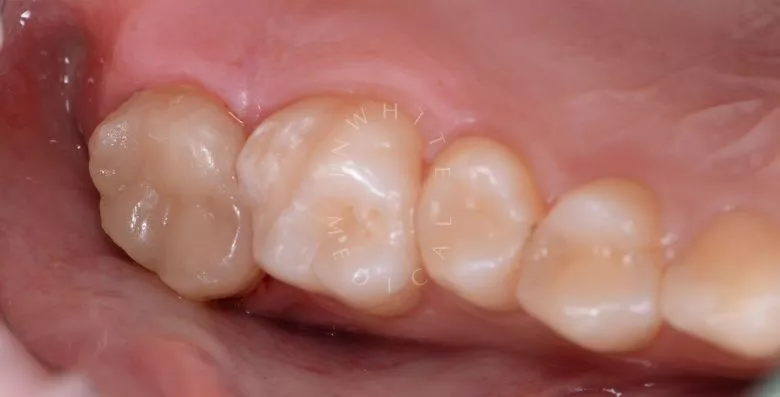 Фото после Глубокий кариес с риском пульпита – терапевтический подход в клинике Inwhite Medical