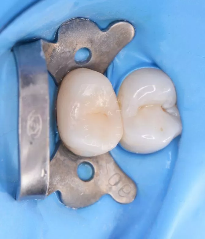 Фото после Контактный кариес: лечение межзубного поражения в клинике Inwhite Medical