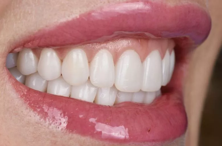 Фото после процедуры