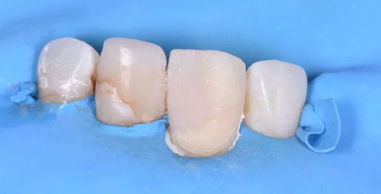 Элитная стоматология. Эстетическая реставрация зуба - фото после процедуры