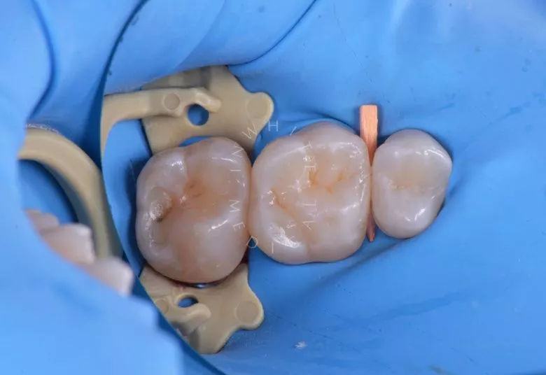 Элитная стоматология. Реставрация зуба с восстановлением естественных фиссур - фото после процедуры